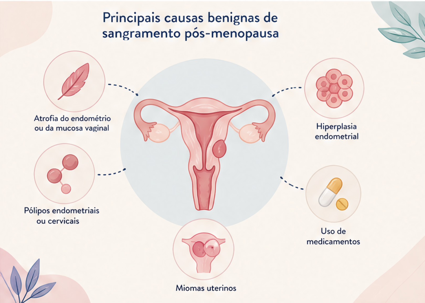 Sangramento Após a Menopausa: pode ser câncer de endométrio?